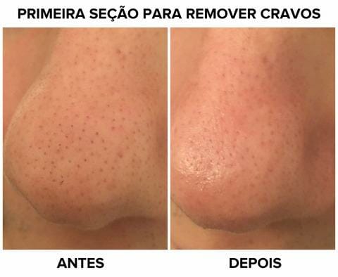 Antes e Depois