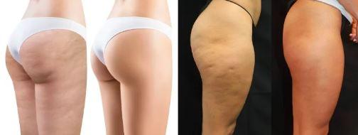 massageador anticelulite eletrico melhor massageador para celulite massageador anti celulite e gordura localizada massageador anti celulite