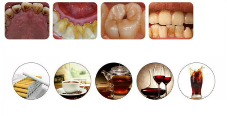 imagem mostrando dentes bem sujos machados com tártaro e placa bacteriana tingidos pelo consumo excessivo de tabaco cigarro chá preto café vinho tinto e coca cola