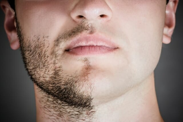 Minoxidil: Como usar na barba, cabelo e sobrancelha